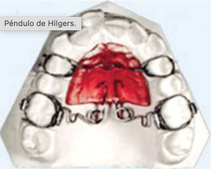 Péndulos en Ortodoncia
