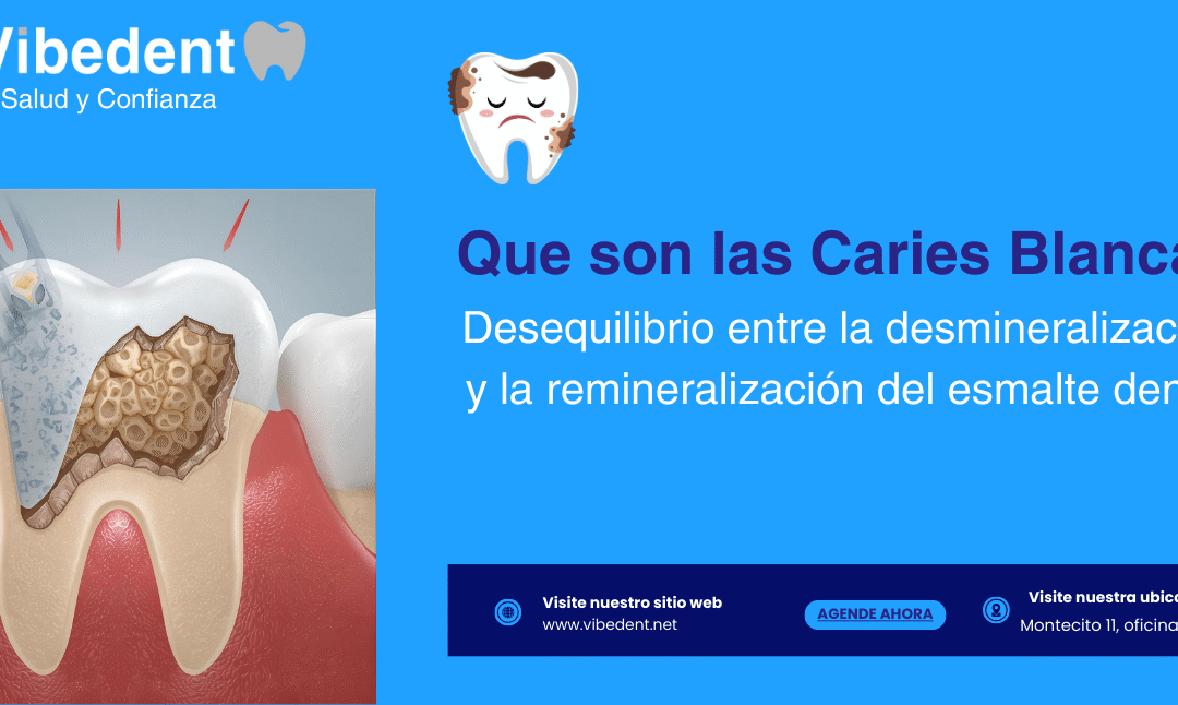 Qué son las Caries Blancas