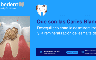 Qué son las Caries Blancas